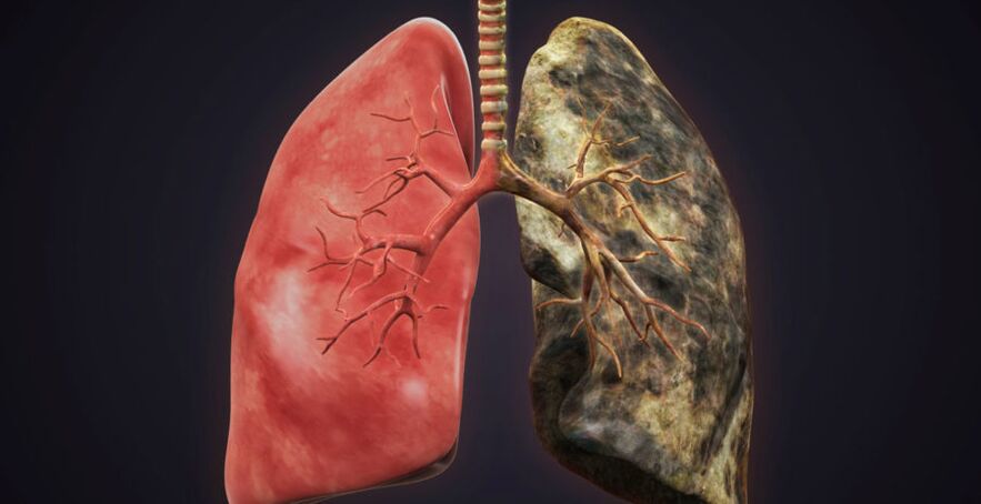 smoker's lung and stop smoking